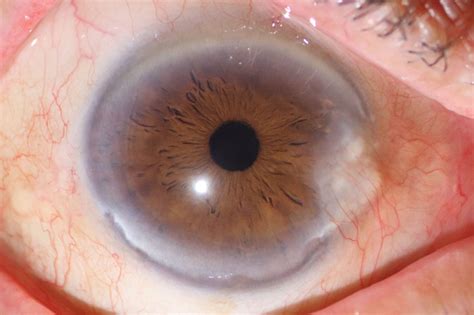 Finding the Right Solution: Expert Advice on Pterygium Surgery Options